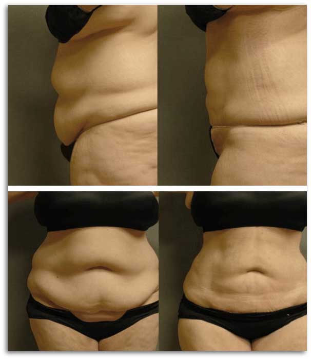 Transformation of woman's tummy from flabby to toned in before and after photos.