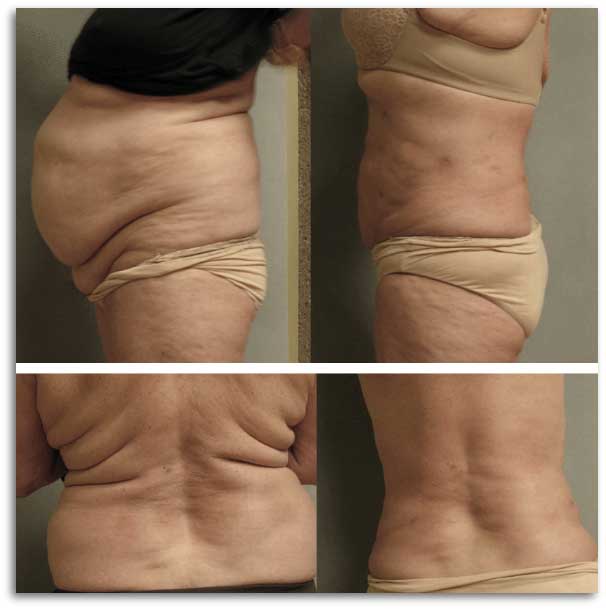 Before and after transformation of a woman's tummy showcasing visible changes in appearance.