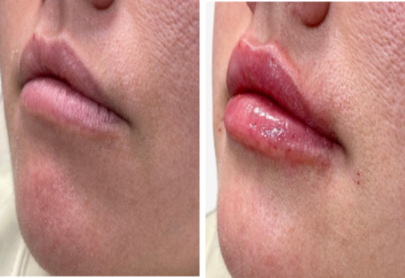 Woman at Euro Med Spa in Chattanooga, TN, received a lip filler treatment