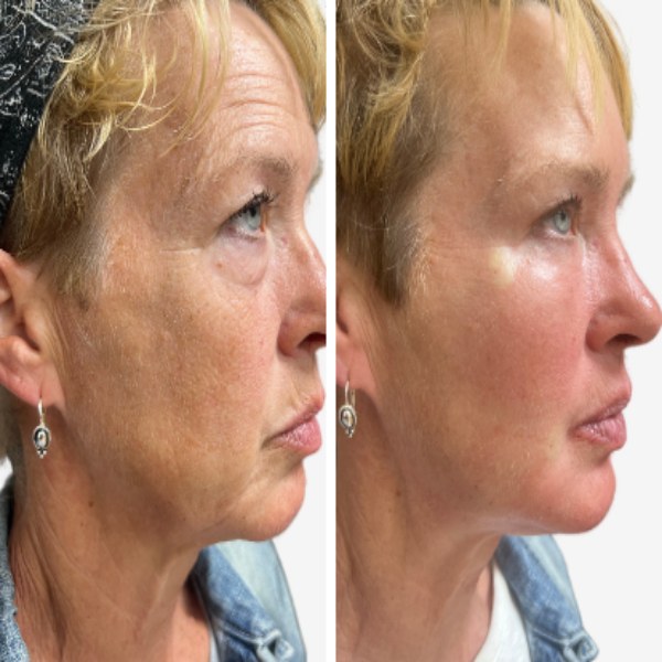 Get Rf micro-needling neuromodulator filler treatment in Chattanooga, TN, at Euro Med Spa