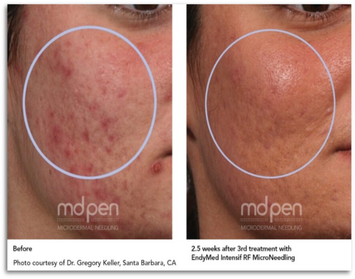 Before and after results of microneedling treatments at Euro Med Spa in Chattanooga, TN