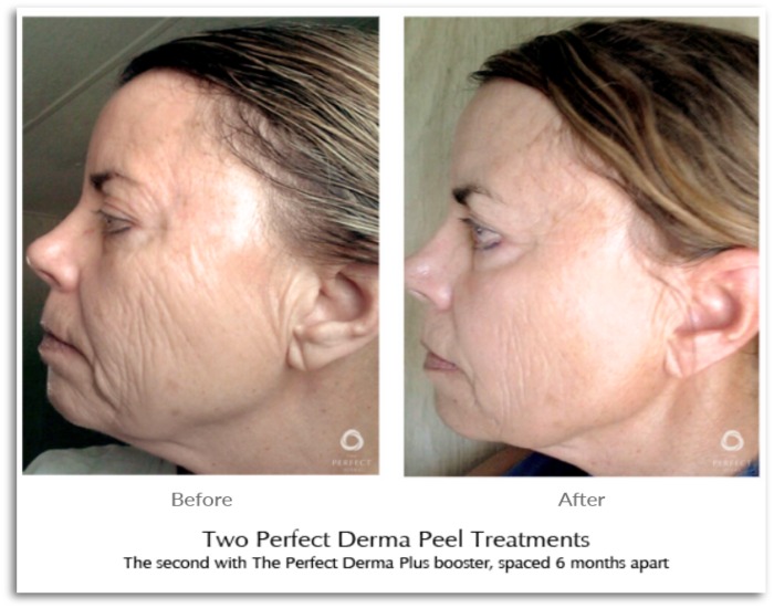 Perfect Derma Peel treatment offered at Euro Med Spa in Chattanooga, TN for flawless skin